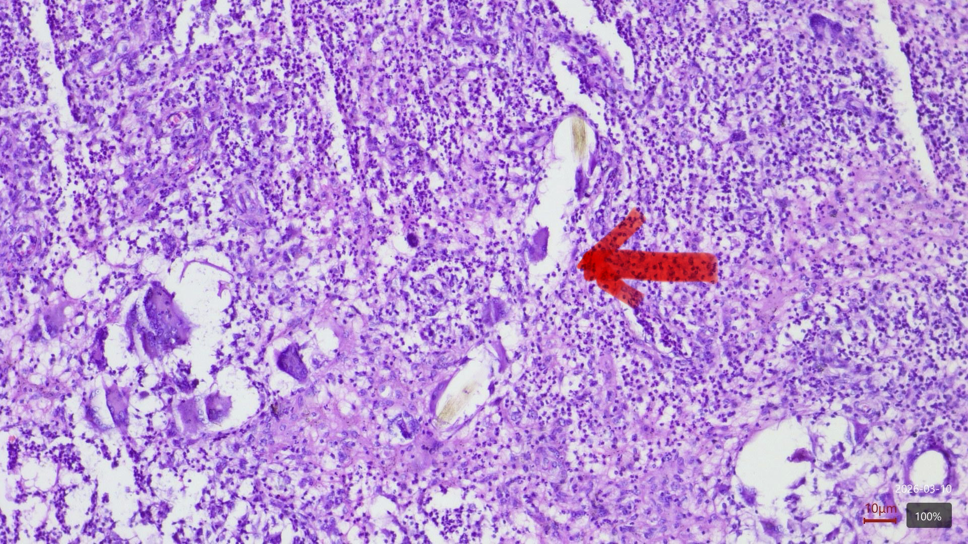 Intermammary pilonidal sinus mimicking acneiform lesions: A rare ectopic presentation